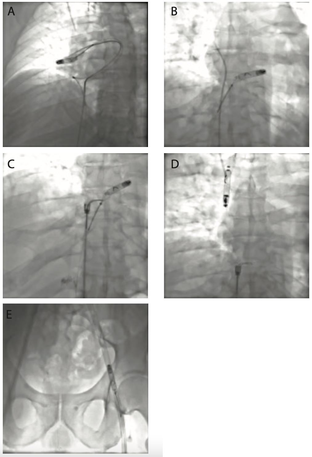 Successful Percutaneous Retrieval of a Leadless Pacemaker From the